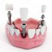 depositphotos_98556602-stock-photo-dental-implant-detail-500x500