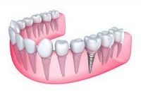protese=dentaria=em-sao-goncalo