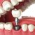 implante-dentario-em-copacabana-1